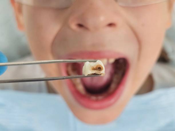 Best Emergency Treatment for Toothache in North Tustin, CA